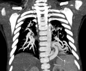 Hình ảnh CT lồng ngực cho thấy phổi biệt lập với mạch máu bất thường xuất phát từ động mạch chủ cấp máu cho khối tổn thương phổi