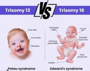 Hình ảnh so sánh đặc điểm giữa trisomy 13 và trisomy 18 với các dấu hiệu hình thái như sứt môi, đầu nhỏ và bàn tay nắm chặt