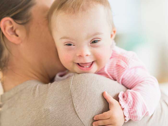 Hình ảnh trẻ mắc hội chứng Down được mẹ ôm, thể hiện đặc điểm khuôn mặt điển hình và sự phát triển trong môi trường chăm sóc gia đình