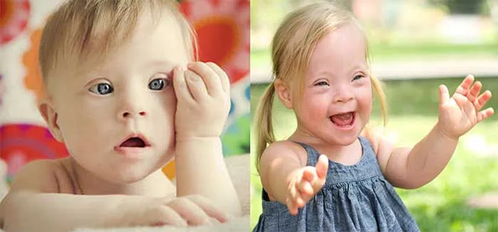 Hình ảnh trẻ mắc hội chứng Down với đặc điểm khuôn mặt điển hình như mắt xếch, sống mũi thấp và biểu cảm đặc trưng