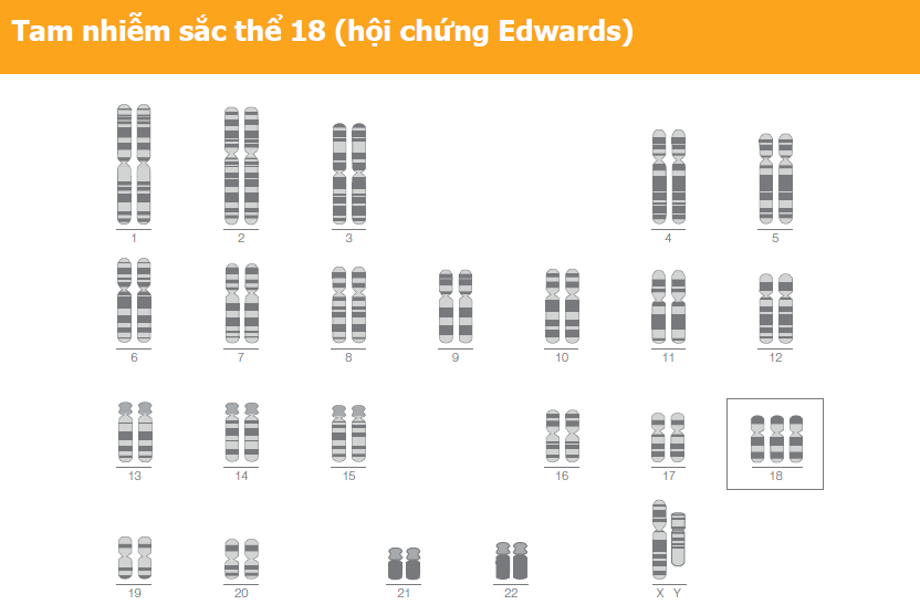 Hình ảnh bộ nhiễm sắc thể trisomy 18 với ba nhiễm sắc thể số 18 – minh họa cơ chế hội chứng Edwards