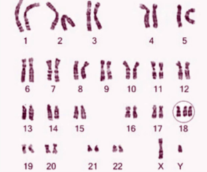 Hình ảnh nhiễm sắc thể trisomy 18 với ba bản sao nhiễm sắc thể 18, đặc trưng của hội chứng Edwards