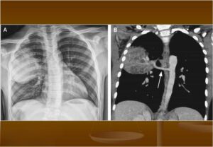 X-quang ngực và CT lồng ngực cho thấy khối phổi biệt lập với mạch máu bất thường từ động mạch chủ