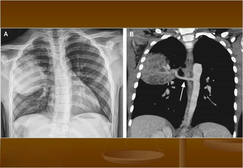 X-quang ngực và CT lồng ngực cho thấy khối phổi biệt lập với mạch máu bất thường từ động mạch chủ