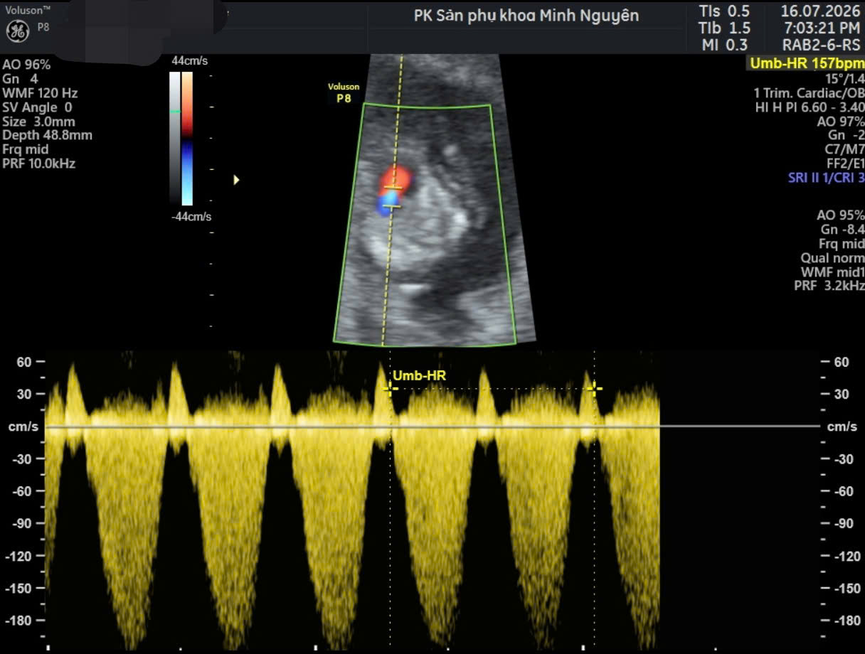 Doppler hở van nhĩ thất ở thai 12 tuần