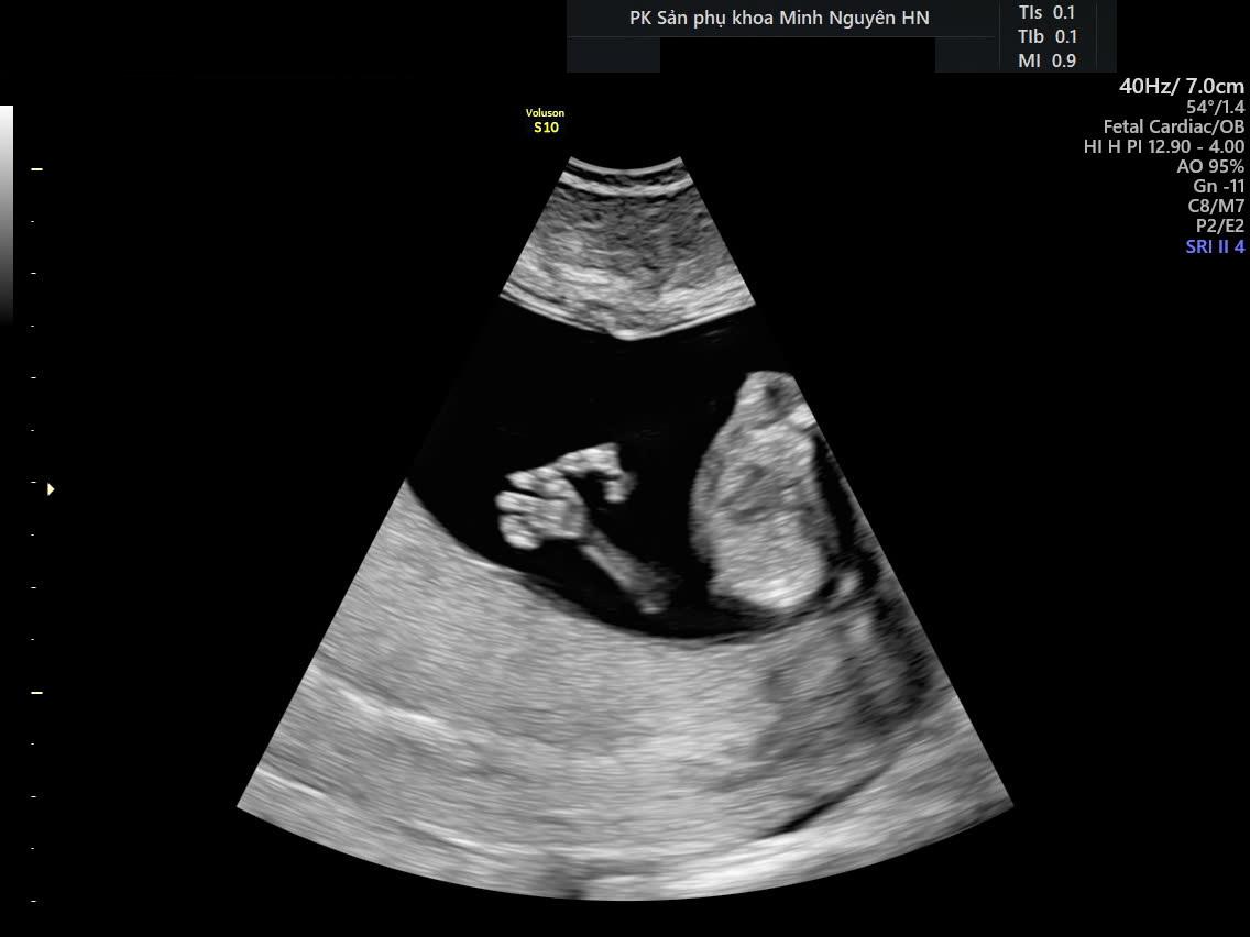 Siêu âm bàn tay có sáu ngón ở thai 12 tuần NIPT nguy cơ cao Trisomy 13 tại Phòng khám Sản phụ khoa Minh Nguyên