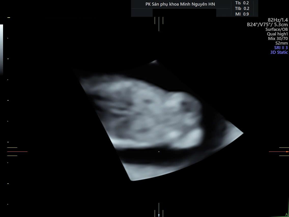 Siêu âm thai 12 tuần ghi nhận bất thường thận hai bên trong ca NIPT nguy cơ cao Trisomy 13 tại Phòng khám Sản phụ khoa Minh Nguyên