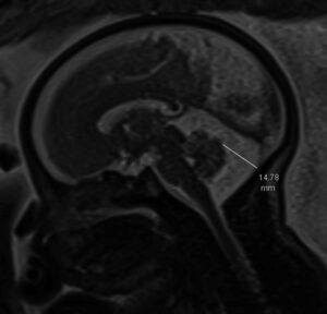 MRI thai nhi mặt cắt dọc giữa cho thấy bể lớn hố sau giãn, đo 14,78 mm