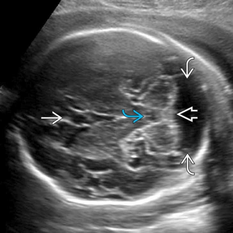Mặt cắt axial siêu âm thai minh họa vùng hố sau và bể lớn