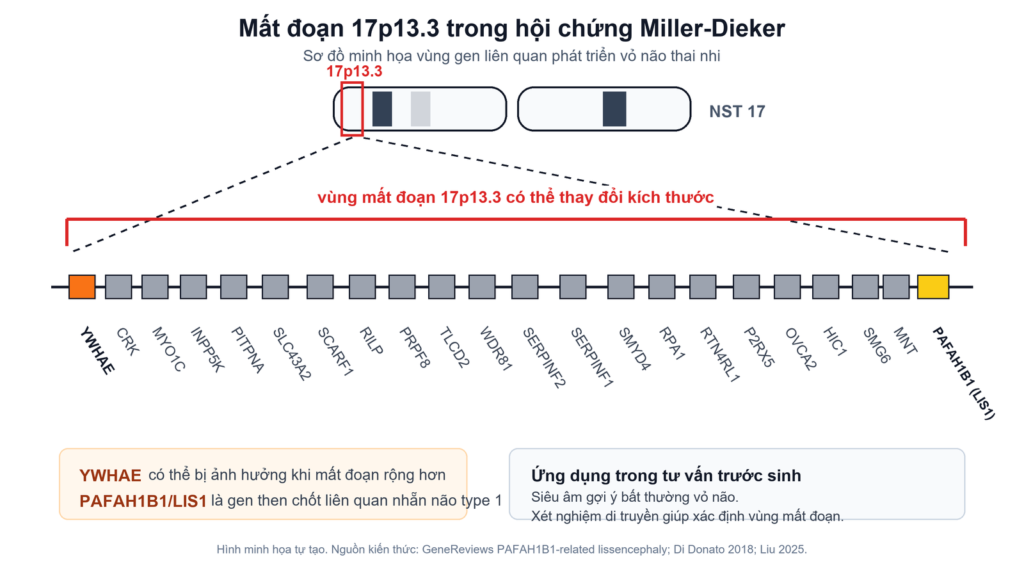 Minh họa vùng 17p13.3 liên quan hội chứng Miller-Dieker, gồm PAFAH1B1/LIS1 và có thể bao gồm YWHAE tùy kích thước mất đoạn. Hình tự tạo nhằm giải thích cơ chế di truyền, không thay thế kết quả xét nghiệm của từng thai kỳ.