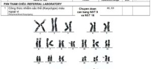 Karyotype đã ẩn danh trong ca sảy thai liên tiếp nghi chuyển đoạn nhiễm sắc thể