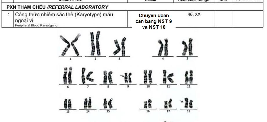 Karyotype đã ẩn danh trong ca sảy thai liên tiếp nghi chuyển đoạn nhiễm sắc thể