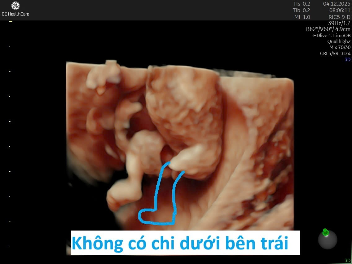 Siêu âm 3D ca dải sợi ối với không thấy chi dưới trái