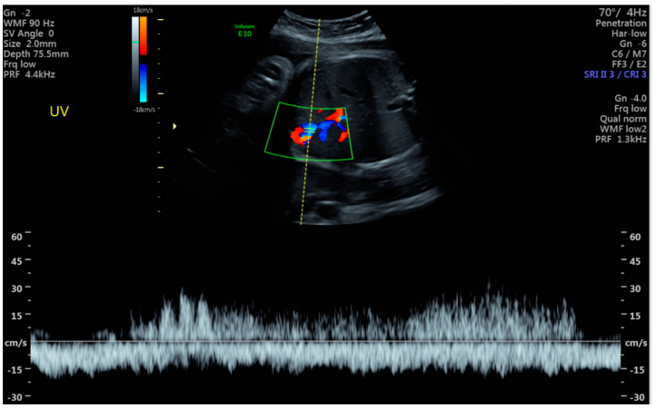 Doppler màu và phổ xác nhận dòng chảy trong vùng giãn tĩnh mạch rốn của thai