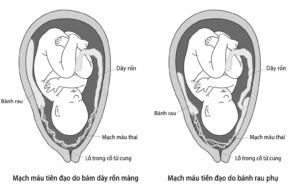 Sơ đồ giải phẫu hai dạng mạch máu tiền đạo, minh họa mạch máu thai chạy sát hoặc bắc qua lỗ trong cổ tử cung