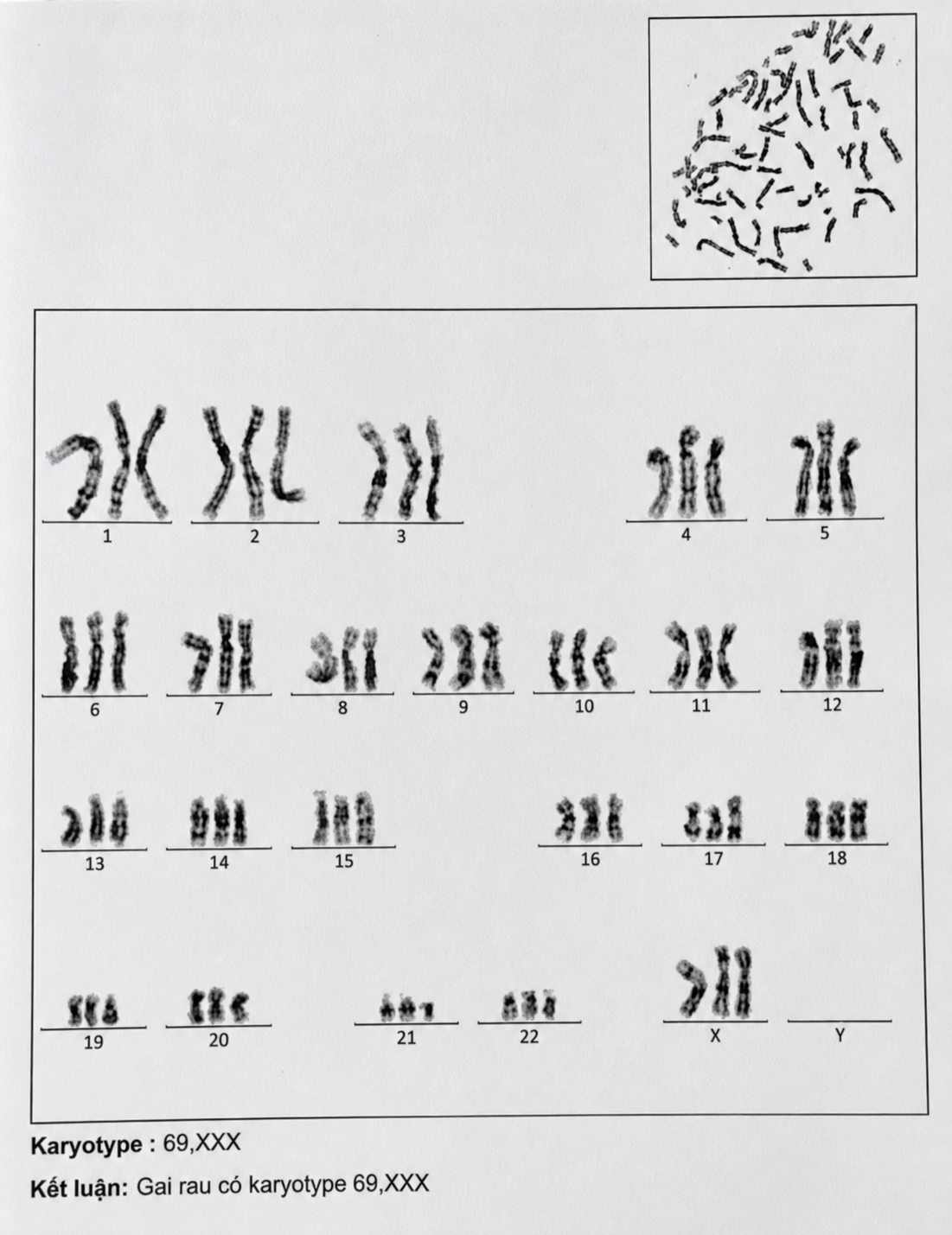 Nhiễm sắc thể đồ gai rau cho kết quả karyotype 69,XXX trong thai tam bội