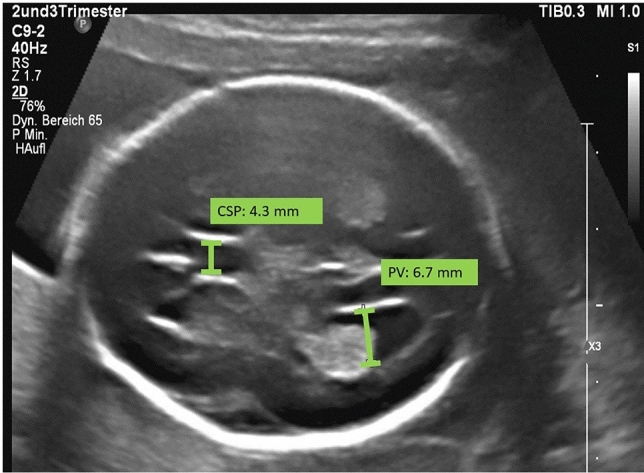 Siêu âm mặt cắt transventricular thai 24 tuần minh họa đo não thất bên với caliper đặt ở bờ trong