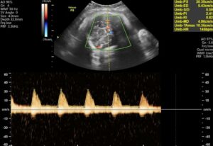 Ảnh Doppler màu và phổ Doppler động mạch rốn từ hồ sơ siêu âm thực tế