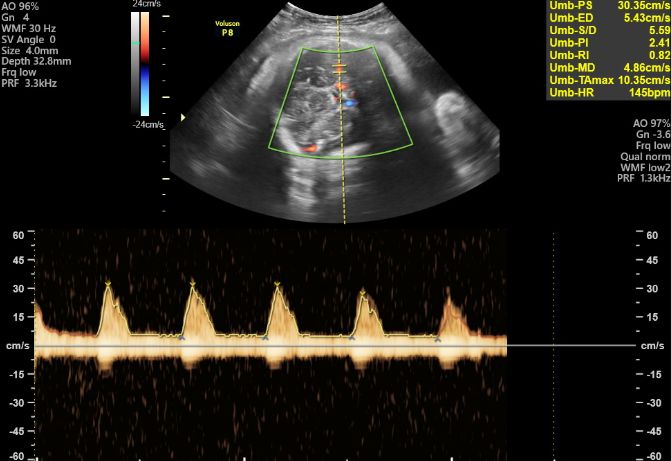 Ảnh Doppler màu và phổ Doppler động mạch rốn từ hồ sơ siêu âm thực tế
