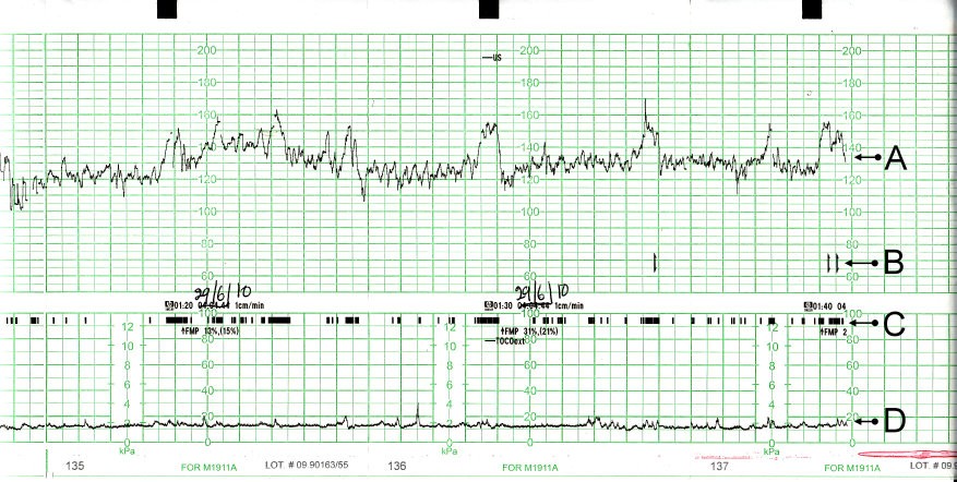 Băng ghi monitor tim thai CTG của thai phụ chưa chuyển dạ, thể hiện nhịp tim thai, cử động thai và cơn co tử cung