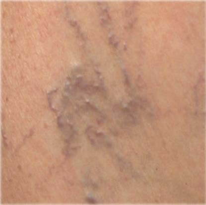 Giãn mao mạch dạng mạng nhện hình nhánh cây trên da chân