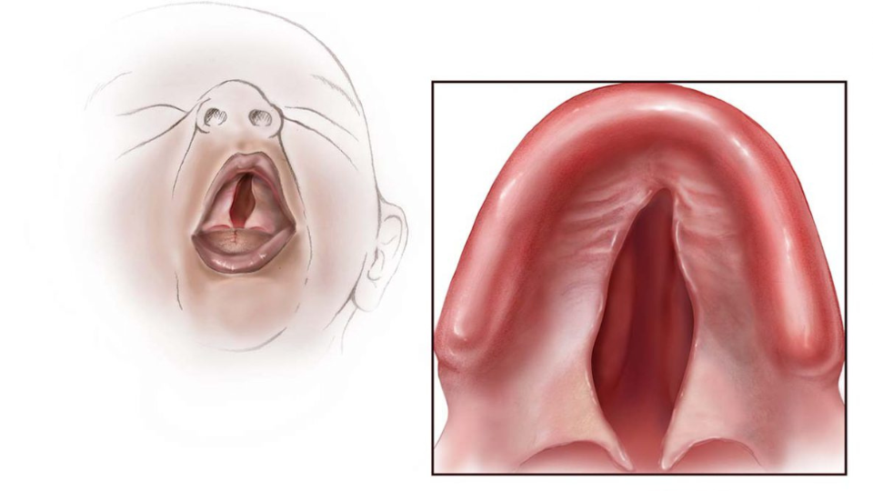 Minh họa giải phẫu khe hở khẩu cái ở vòm miệng nhìn từ dưới