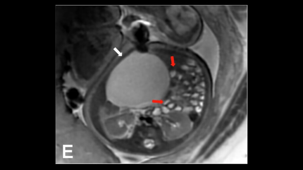 MRI thai 33 tuần thấy nang buồng trứng phải lớn đẩy các quai ruột non sang trái