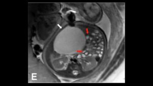 MRI thai 33 tuần thấy nang buồng trứng phải lớn đẩy các quai ruột non sang trái
