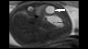 MRI thai 28 tuần mặt cắt ngang bụng, mũi tên chỉ nang lách cạnh dạ dày