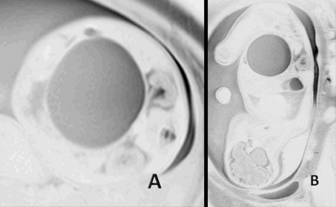 Hai lát cắt MRI thai 32 tuần cho thấy nang mạc treo chiếm chỗ trong ổ bụng