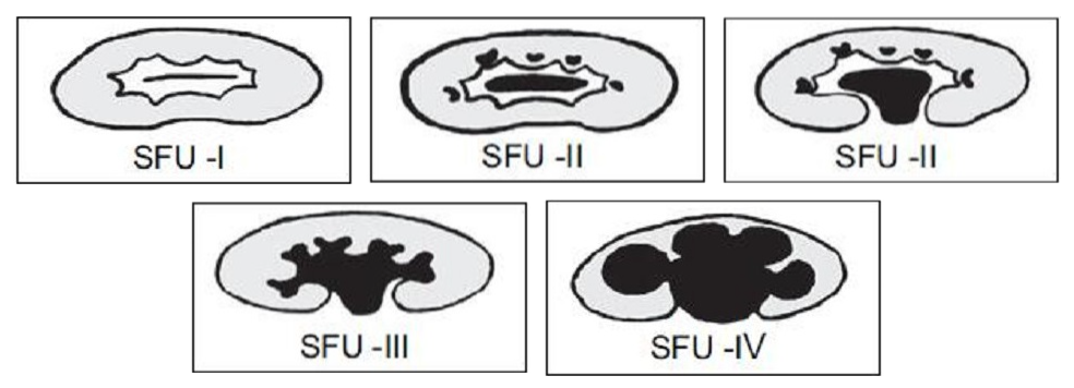 Hình phân độ giãn bể thận theo SFU từ độ I đến độ IV, mức giãn lan dần từ bể thận ra các đài thận