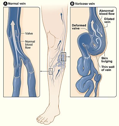 Minh họa tĩnh mạch bình thường và tĩnh mạch bị suy giãn ở chân