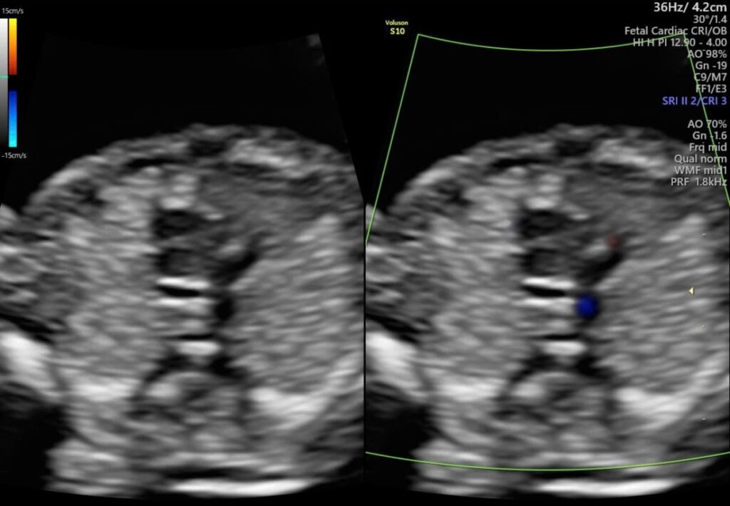 Ảnh siêu âm vùng tim thai khoảng 13 tuần ở hai khung 2D và Doppler màu.