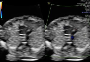 Ảnh siêu âm vùng tim thai khoảng 13 tuần ở hai khung 2D và Doppler màu.