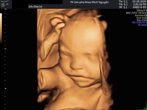 Hình dựng vùng mặt 3D ở thai 30 tuần 1 ngày trong case hở hàm